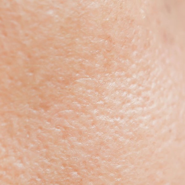 Artikel over acne - hoofdpagina