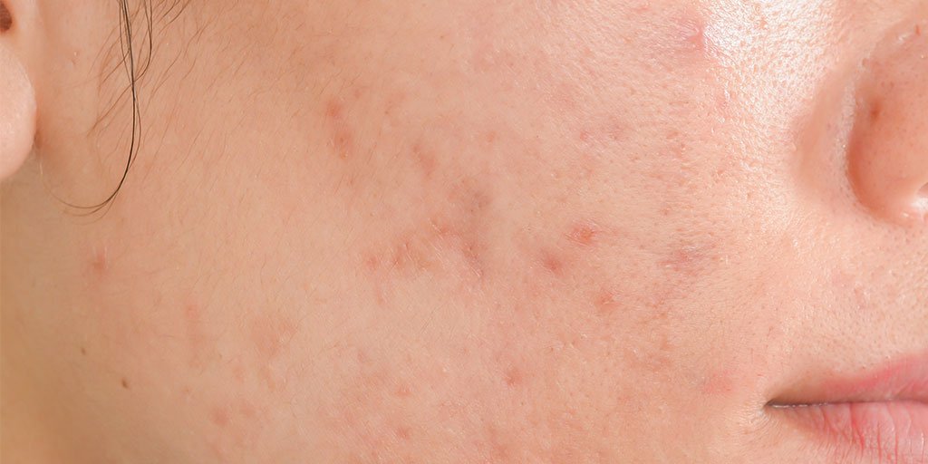 Verminder Vlekken En Littekens Na Acne La Roche Posay