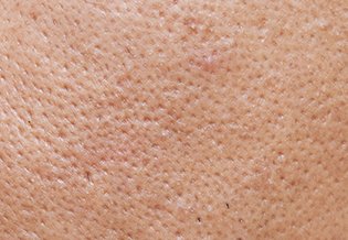 Larocheposay ArticlePage Acne How to get rid of blackheads