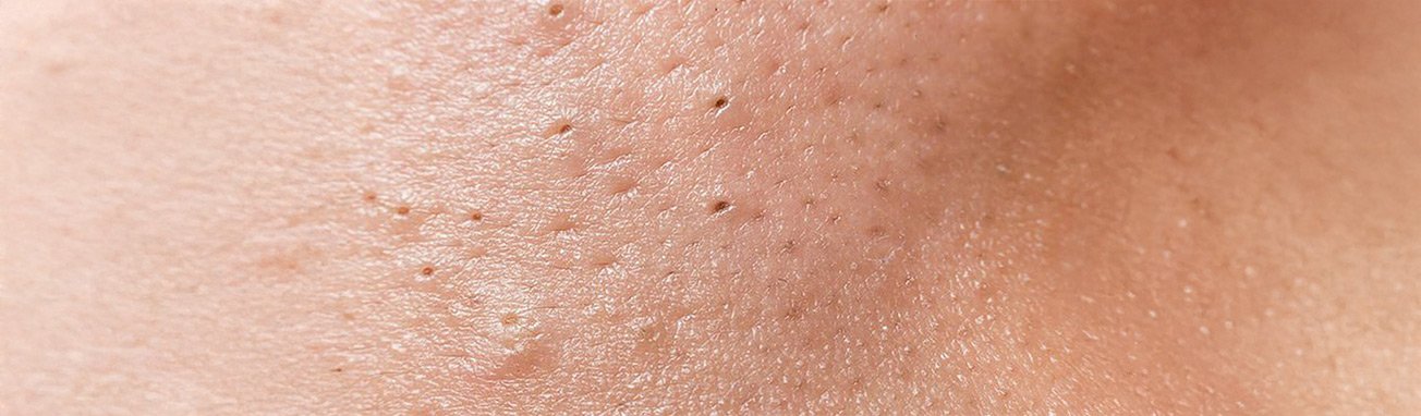 Artikel over acne - hoofdpagina