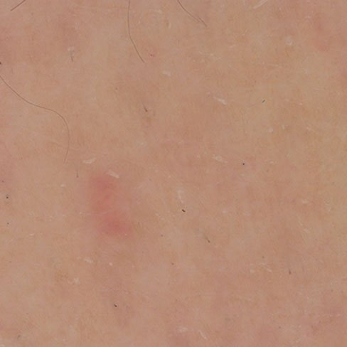 Urea after